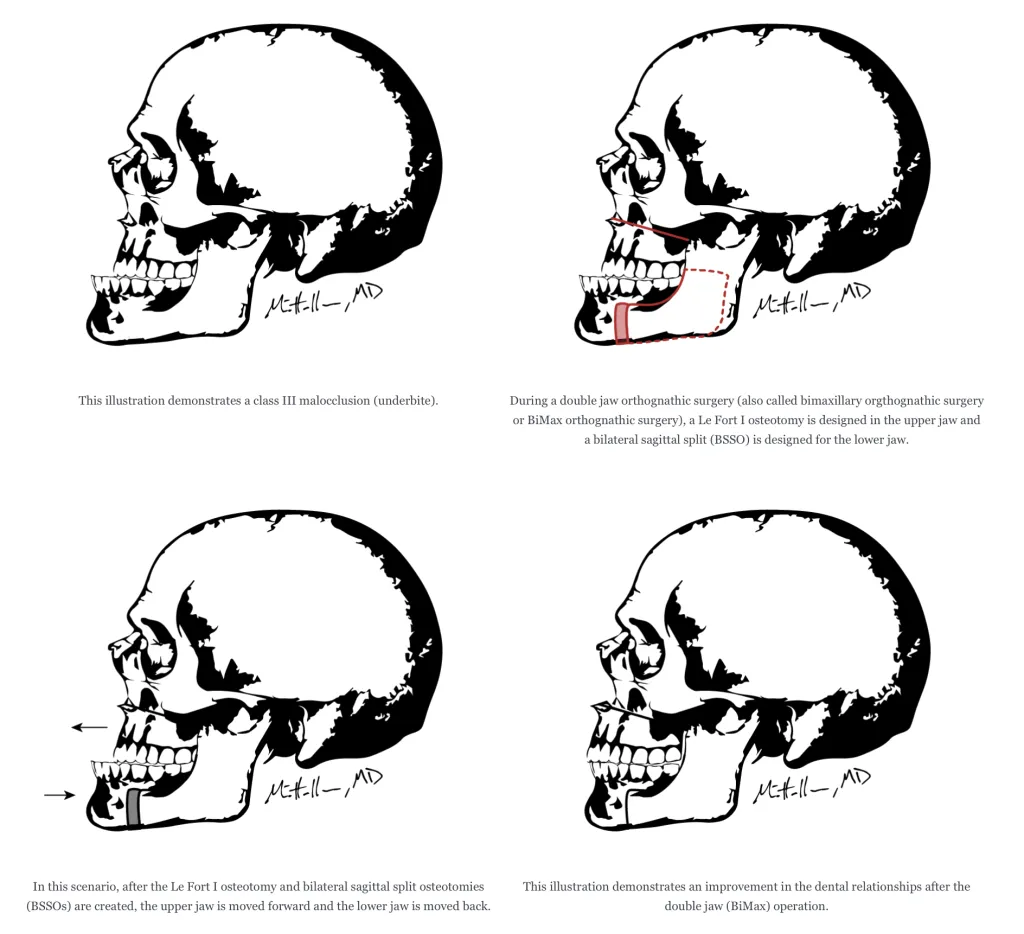 Double jaw surgery illustration showing an underbite, planned jaw adjustments, and the improved bite position after surgery.