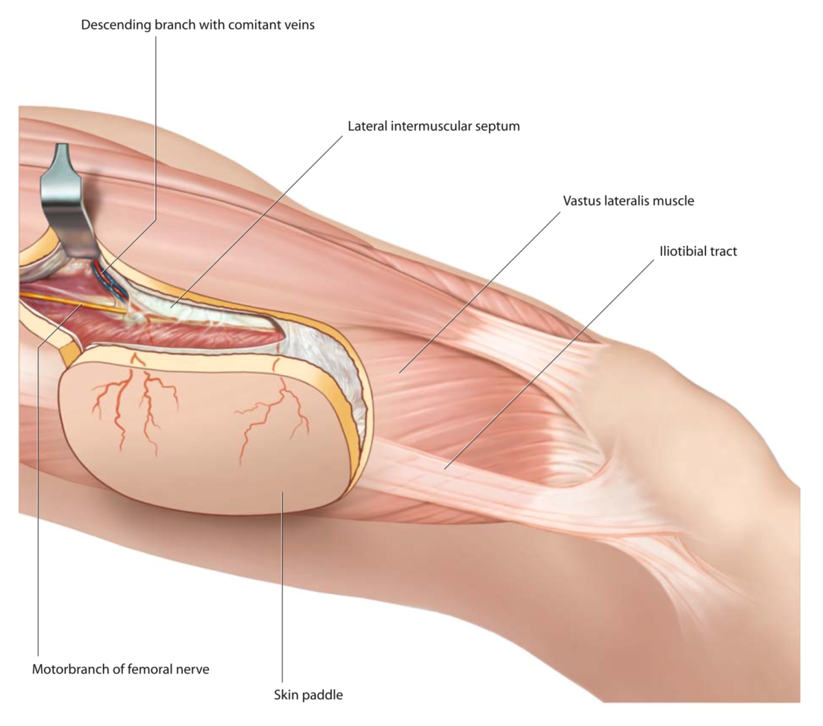 Medical illustration of single scar phalloplasty