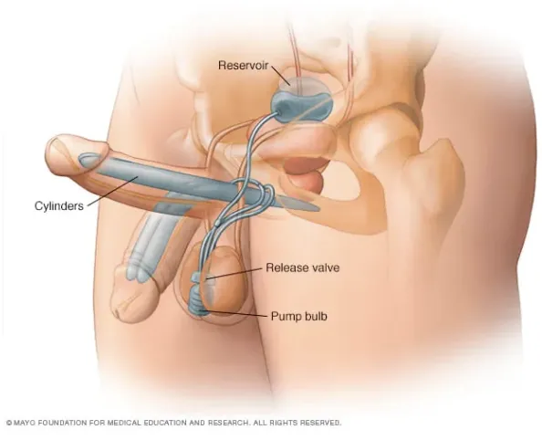 Medical illustration showing erectile device and testicular implant placement