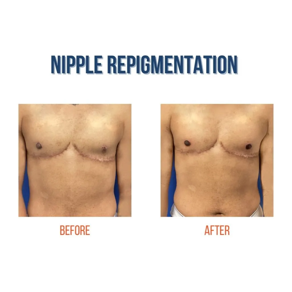 Before and After nipple repigmentation photos