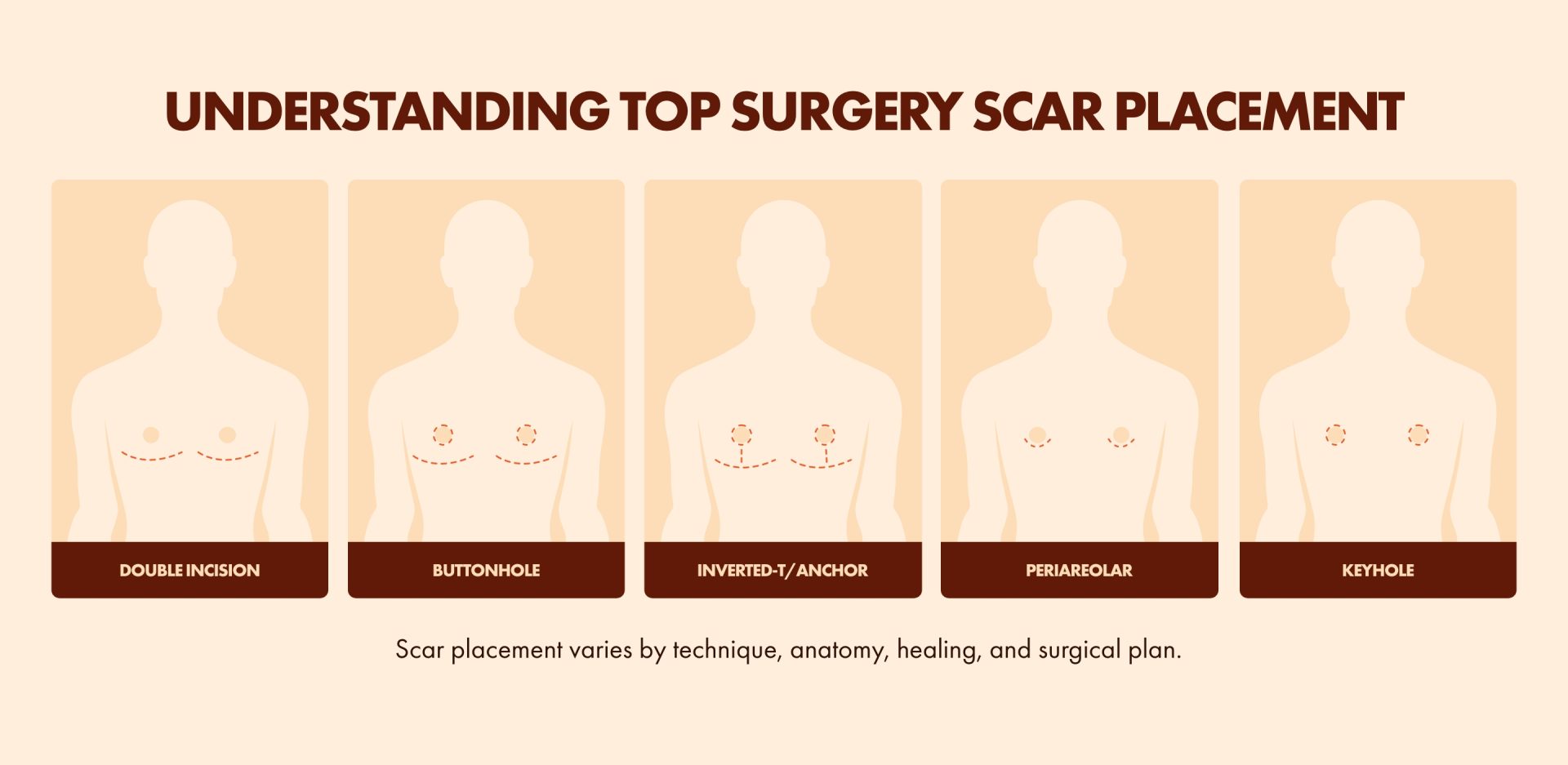 Graphic about top surgery scar placement.